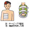 骨折
